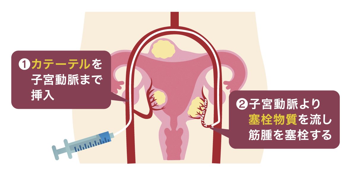 子宮温存が叶う子宮筋腫の治療法「子宮動脈塞栓術(UAE)」｜最新治療の