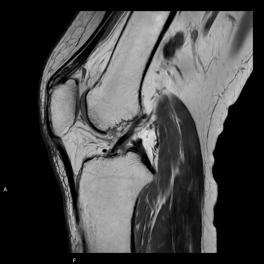 画像：膝MRI（プロトン強調画像）