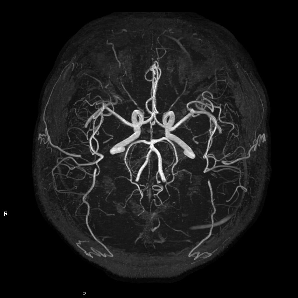 画像：頭部MRA