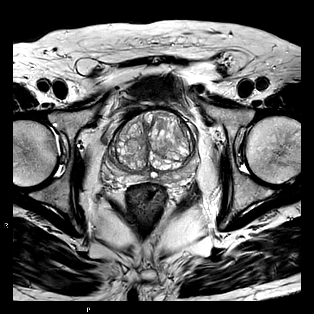 画像：前立腺MRI（T2強調画像）