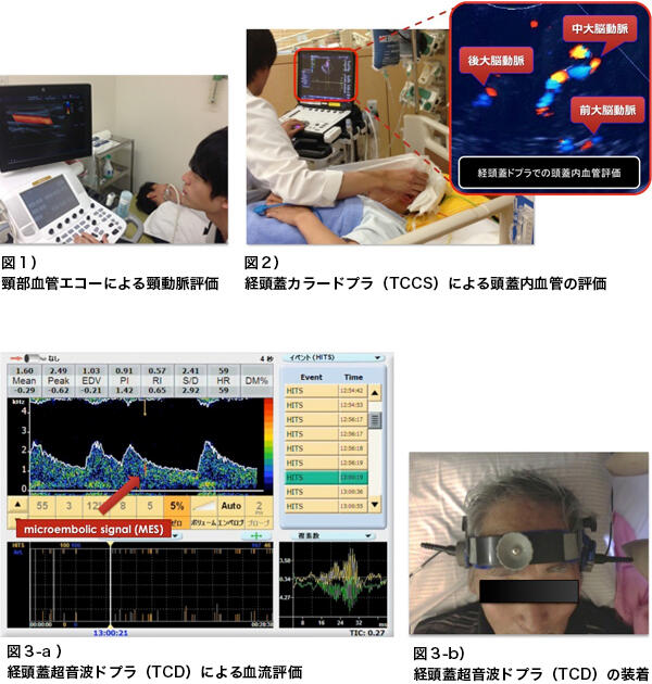 図1）頸部血管エコーによる頸動脈評価 図2）経頭蓋カラードプラ（TCCS）による頭蓋内血管の評価 図3-a）経頭蓋超音波ドプラ（TCD）による血流評価 図3-b）経頭蓋超音波ドプラ（TCD）の装着