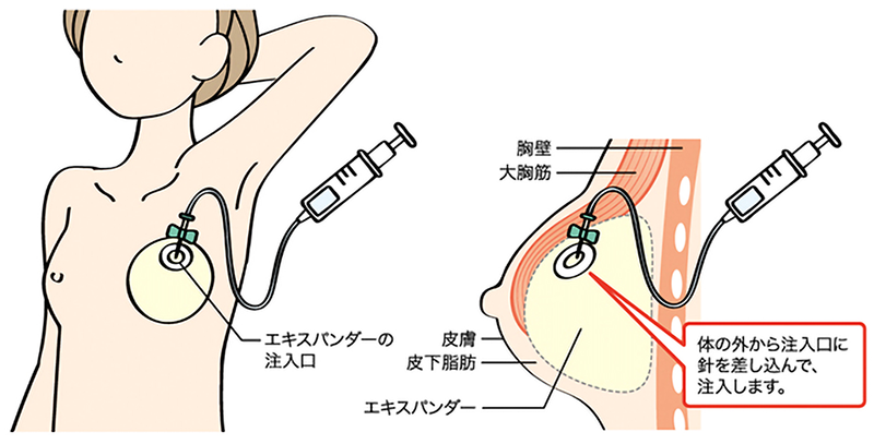 画像：ティッシュ・エキスパンダー(皮膚拡張器)挿入イメージ図