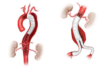 イメージ：ステントグラフト内挿術