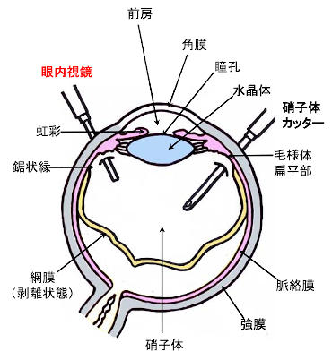 手術イメージ