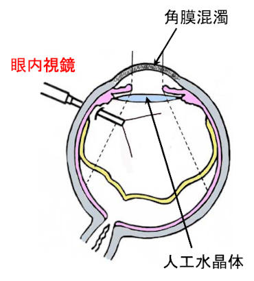 角膜混濁・裂傷