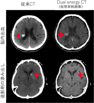 画像：脳血管内血栓回収療法後のDual energy CT