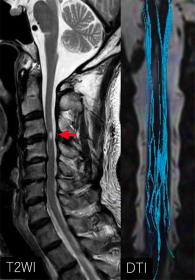 画像：頚椎DTI