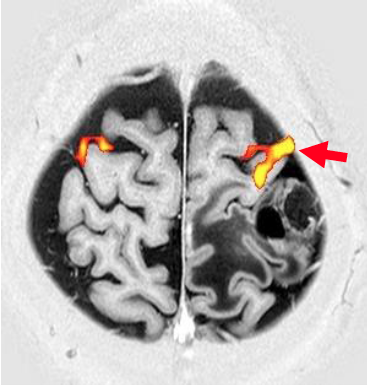 画像:頭部fMRI(右掌握運動)