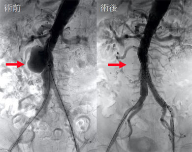 画像：ステントグラフト留置術