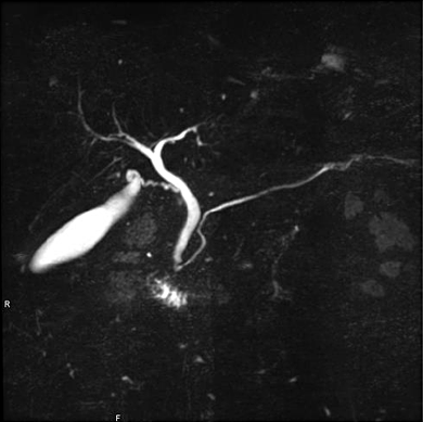 画像:MRCP(飲水なし)